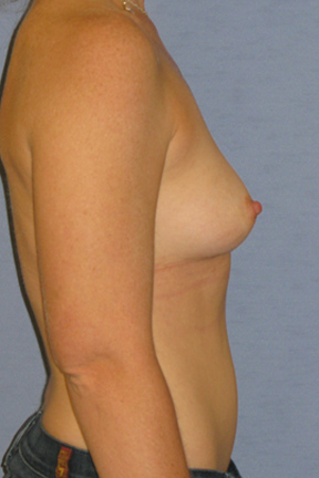 Breast Augmentation Before & After Patient #3752