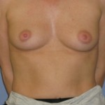 Breast Augmentation Before & After Patient #3775