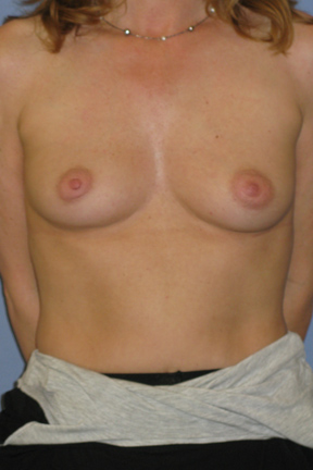 Breast Augmentation Before & After Patient #3775