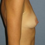 Breast Augmentation Before & After Patient #3641