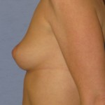 Breast Augmentation Before & After Patient #3775