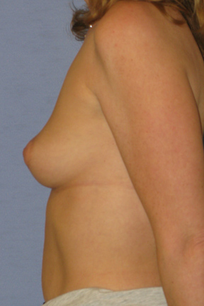 Breast Augmentation Before & After Patient #3775