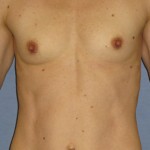 Breast Augmentation Before & After Patient #3785