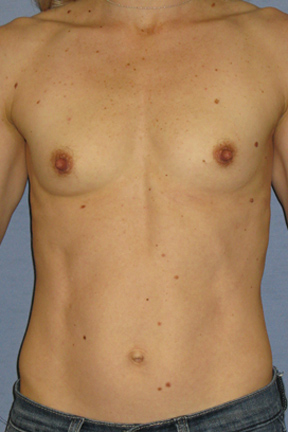 Breast Augmentation Before & After Patient #3785