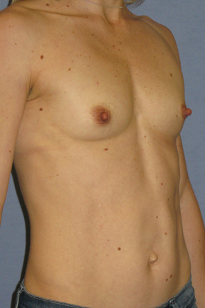 Breast Augmentation Before & After Patient #3785