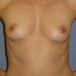 Breast Augmentation Before & After Patient #3792