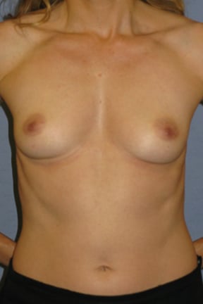 Breast Augmentation Before & After Patient #3792