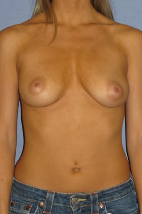 Breast Augmentation Before & After Patient #3798