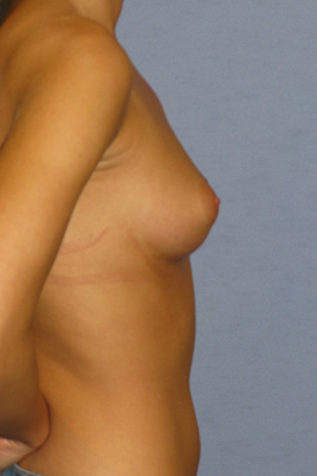 Breast Augmentation Before & After Patient #3798