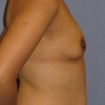 Breast Augmentation Before & After Patient #3810