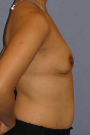 Breast Augmentation Before & After Patient #3810