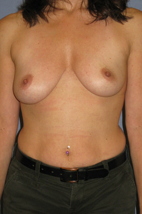 Breast Augmentation Before & After Patient #3825