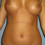 Breast Implants Revision Before & After Patient #3497