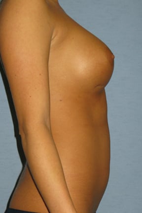 Breast Implants Revision Before & After Patient #3497
