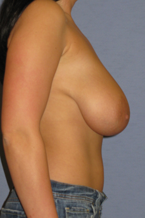 Breast Lift Before & After Patient #3951