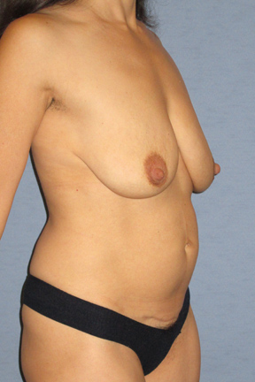 Breast Lift Before & After Patient #3958