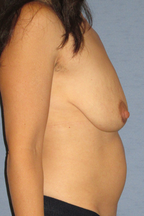 Breast Lift Before & After Patient #3958