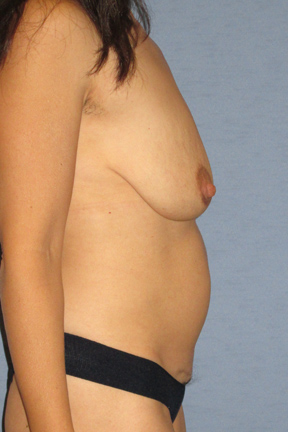 Breast Lift Before & After Patient #3958