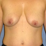 Breast Augmentation Before & After Patient #3977