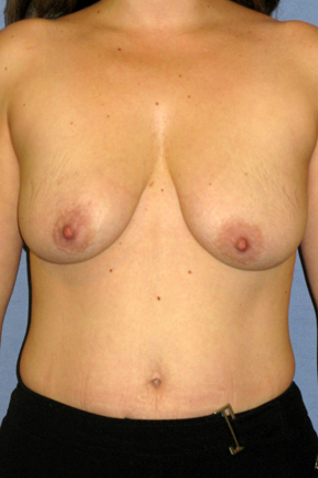 Breast Augmentation Before & After Patient #3977