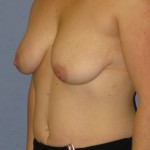 Breast Augmentation Before & After Patient #3977