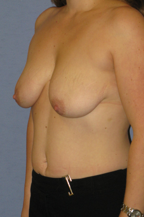 Breast Augmentation Before & After Patient #3977