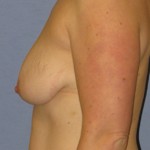 Breast Augmentation Before & After Patient #3977
