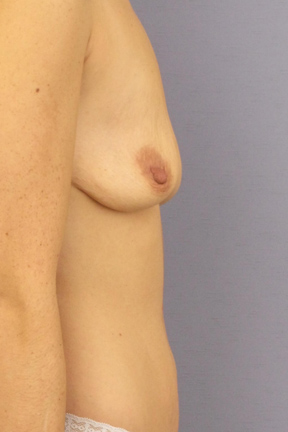 Breast Lift Before & After Patient #3984