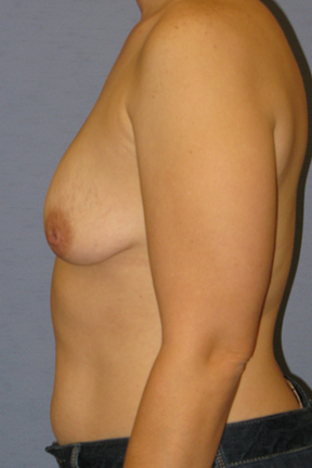 Breast Lift Before & After Patient #3991
