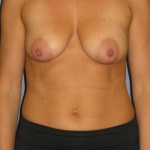 Breast Lift Before & After Patient #4001