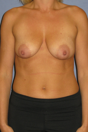 Breast Lift Before & After Patient #4001