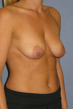 Breast Lift Before & After Patient #4001