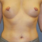Breast Lift Before & After Patient #4018