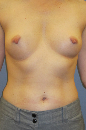 Breast Lift Before & After Patient #4018