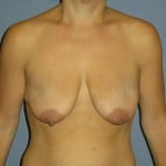Breast Lift Before & After Patient #4023