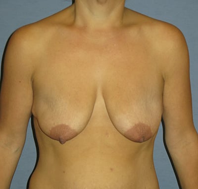 Breast Lift Before & After Patient #4023