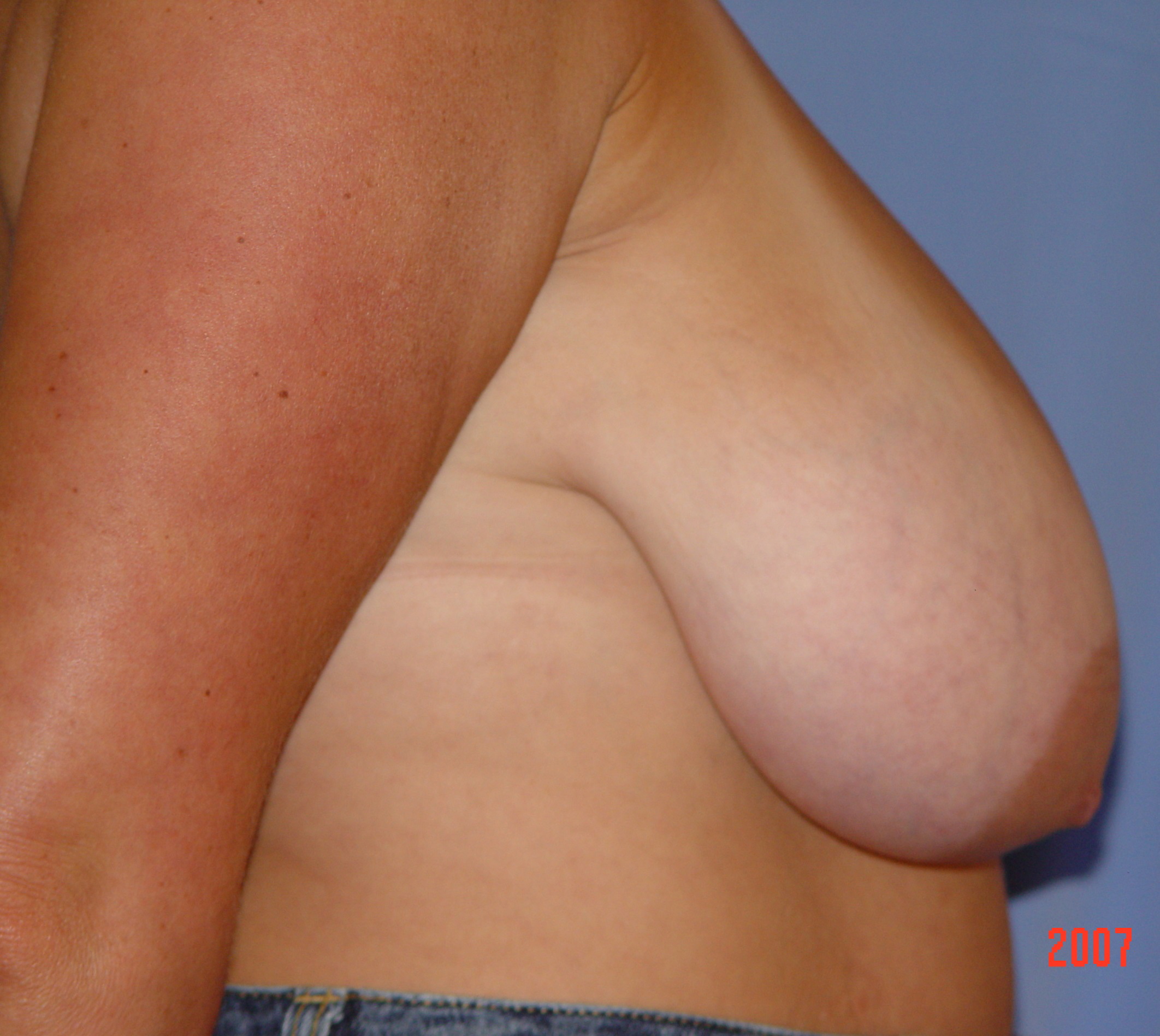 Breast Lift Before & After Patient #4026