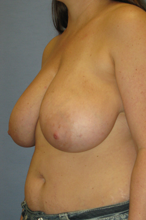 Breast Lift Before & After Patient #3569