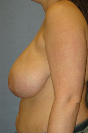 Breast Lift Before & After Patient #3569