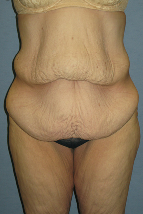 Body Lift Before & After Patient #3556