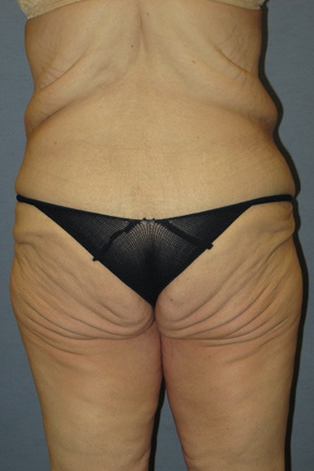 Body Lift Before & After Patient #3556