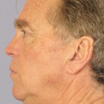 Facelift Before & After Patient #4072