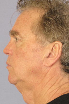 Facelift Before & After Patient #4072