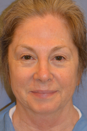 Facelift Before & After Patient #4062