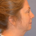 Facelift Before & After Patient #4062