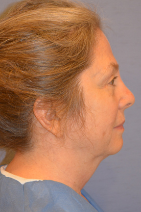 Facelift Before & After Patient #4062