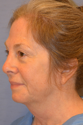 Facelift Before & After Patient #4062