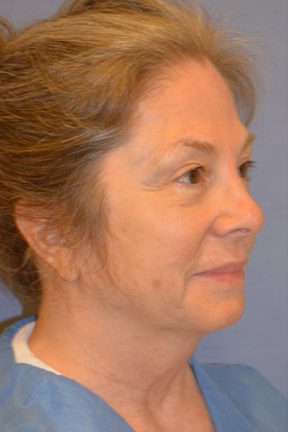 Facelift Before & After Patient #4062