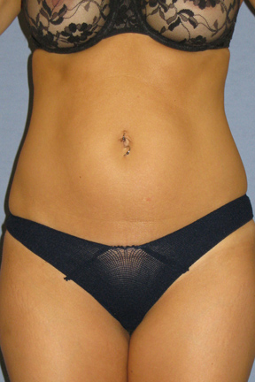 Liposuction Before & After Patient #3508