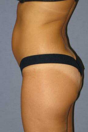 Liposuction Before & After Patient #3508